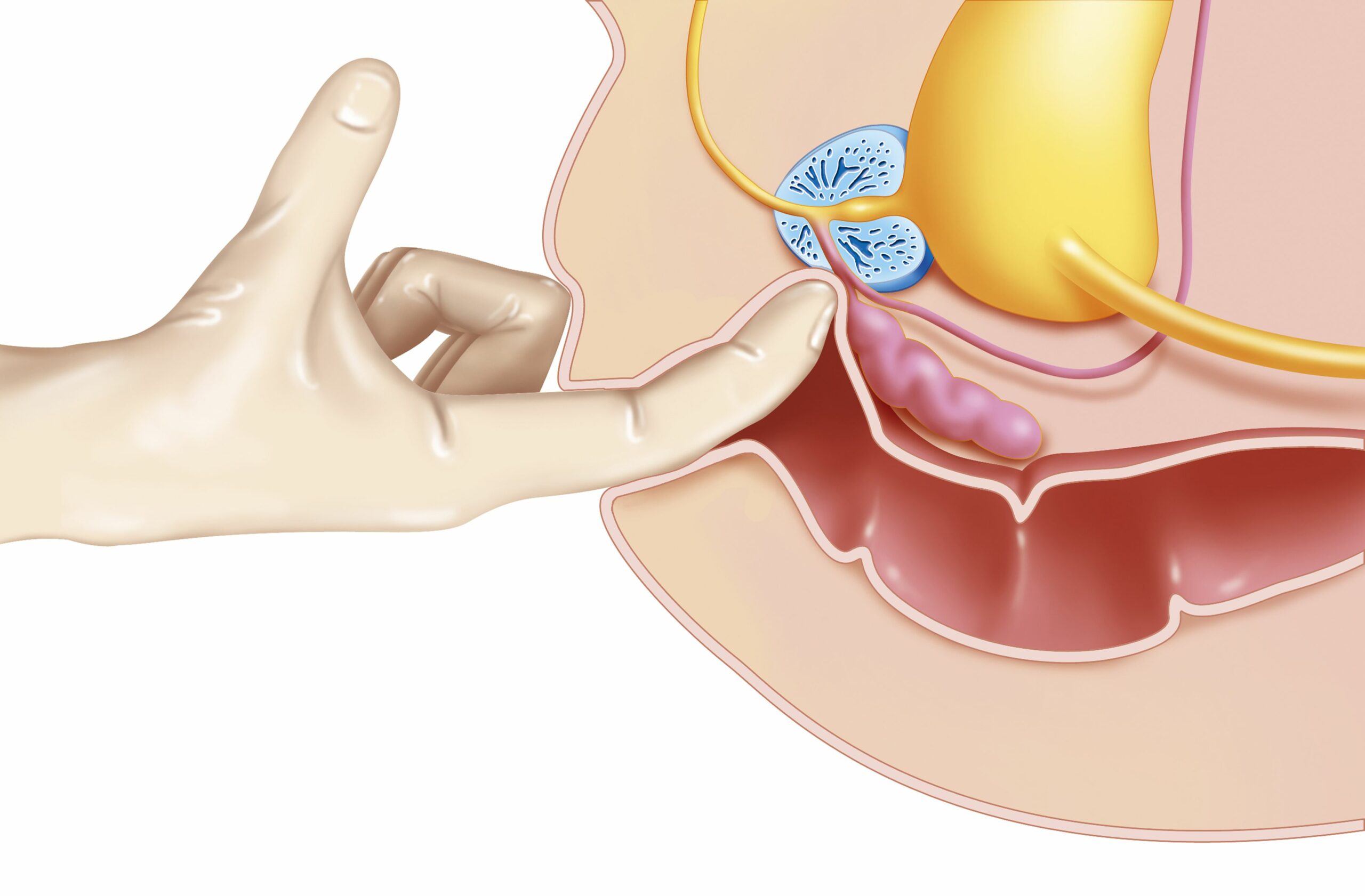 Illustration Of The Third Stage Of A Digital Rectal Examination In The Case Of A Prostate Examination 502865217 5c0af2a94cedfd00014701e6